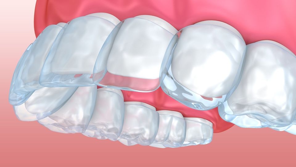 Invisalign Clear Aligners Vs. Braces - Scarborough Dentist